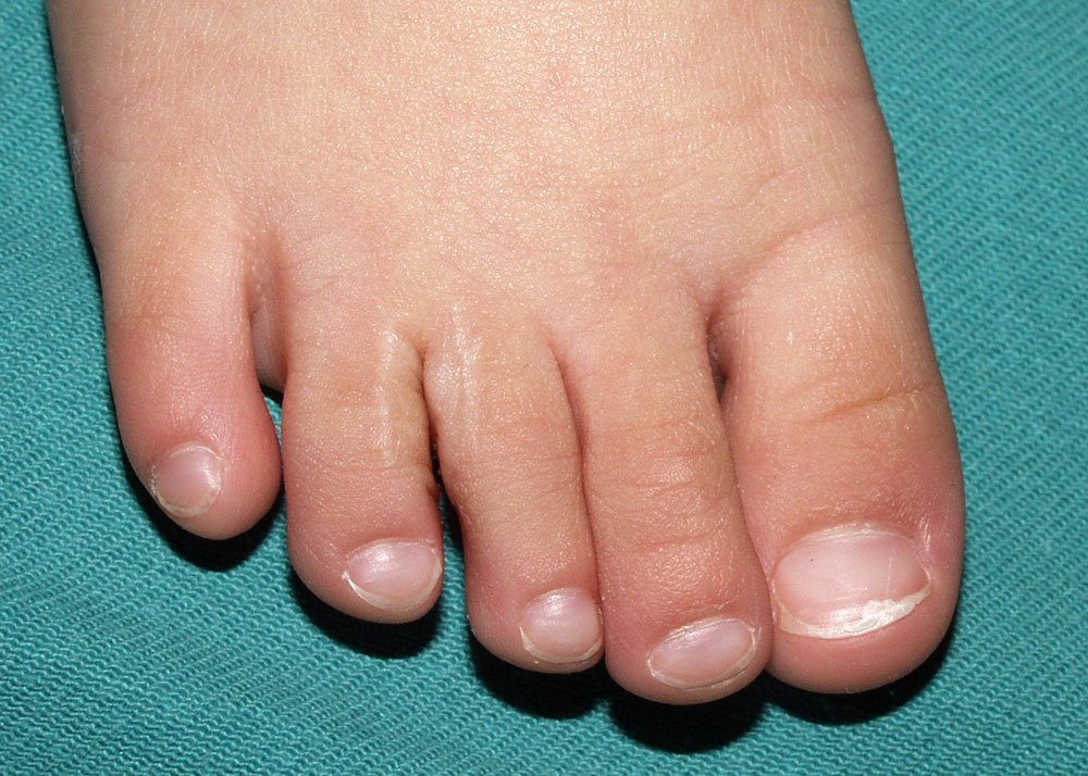 形成外科シリーズ-⑤　先天性の手足の変形　合趾症術後